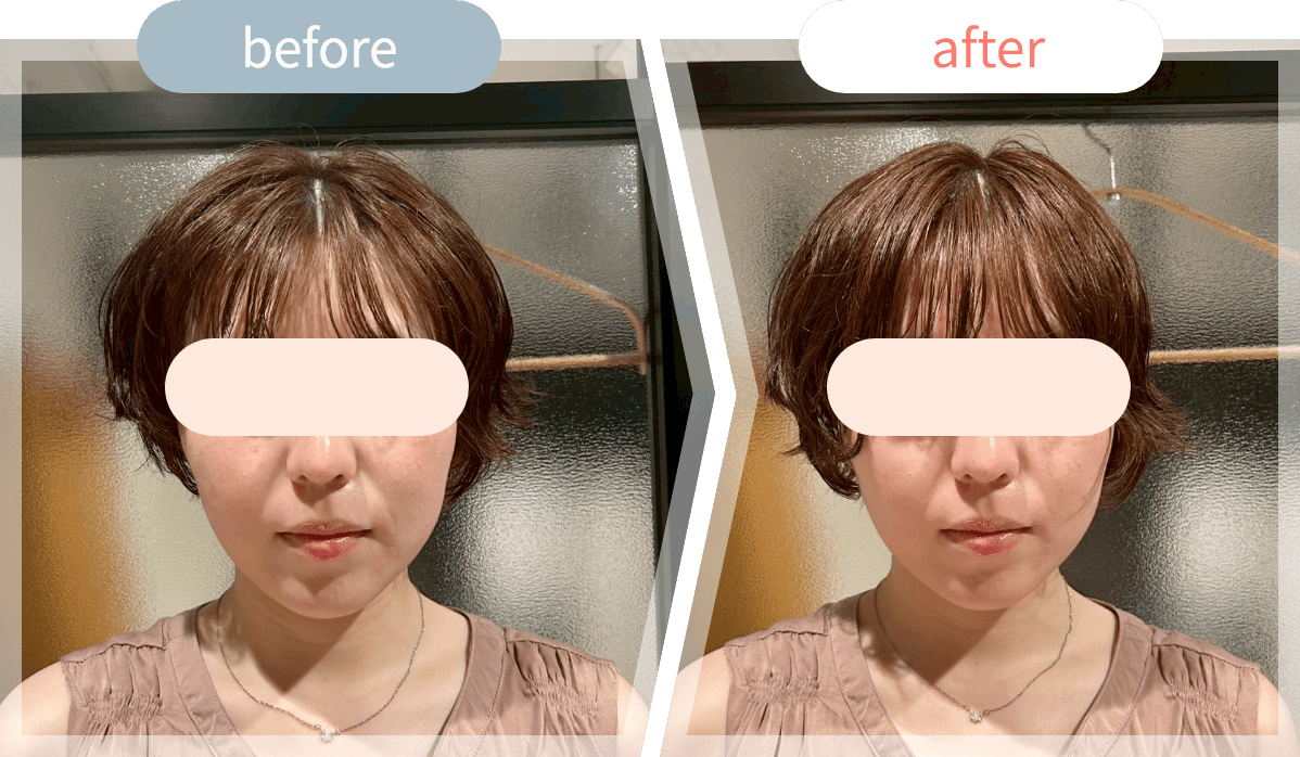 施術前後の顔写真